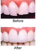 cerec_veneers CEREC Veneers