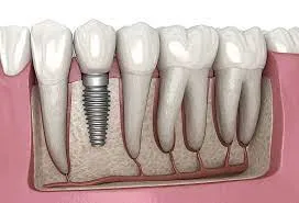 dental-implants